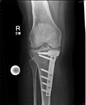 02_osteotomy_pic.jpg