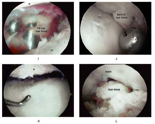 arthrofibrosis of the knee