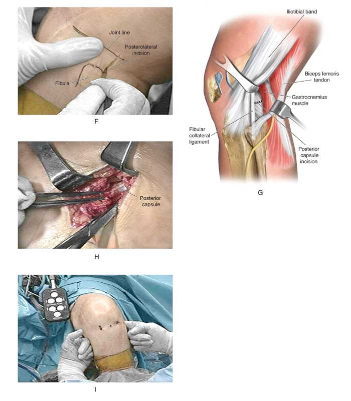lysis of adhesions of the knee