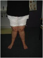 7a_valgus_photo.jpg