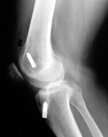 ACLleftxray.jpg