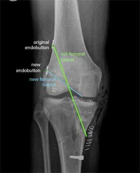ACL revision