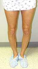 bow legs