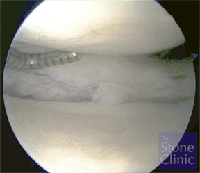 meniscal tear