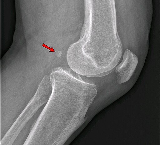 The fabella ossicle in the knee/