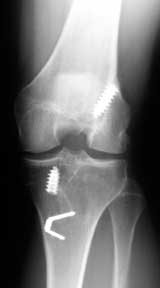 ACL graft in anatomic position