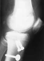 patella infera