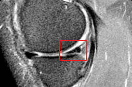 MRI at three weeks