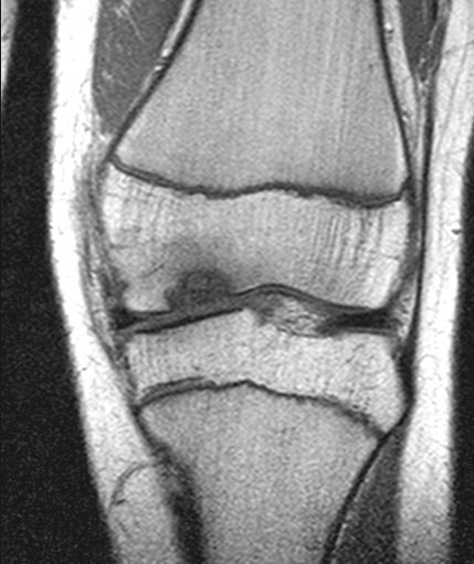 MRI slice demonstrating osteochondrosis dissecans.