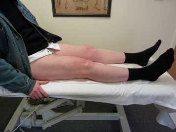 twelve weeks after osteotomy