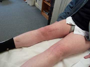 twelve weeks after osteotomy