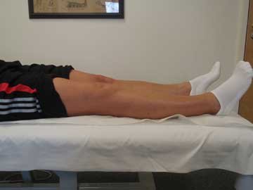 twelve weeks after osteotomy