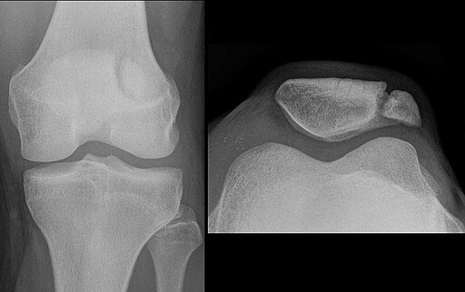Bipartite patella or kneecap.