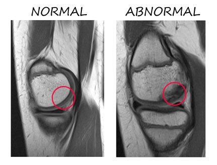 OCD lesion on right