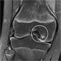 OCD on mri