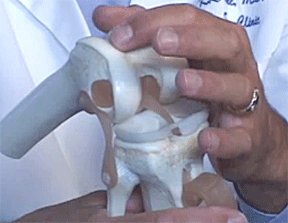 A plastic knee model with the surgeon pointing to the articular knee cartilage covering the rounded condyle of the femur.