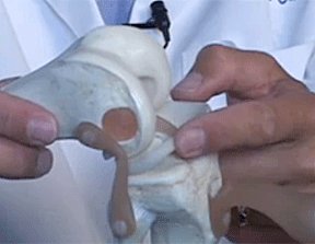 Illustration of surgeon using a plastic model and pointing to the knee meniscus.