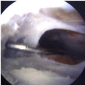 Plical excision