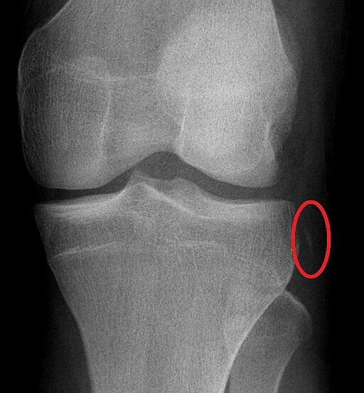A small avulsion fracture that is often missed is the Segond Fracture.