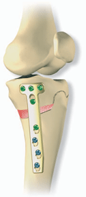 high tibial osteotomy
