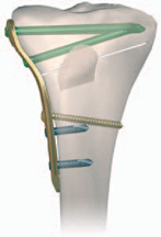 Closing wedge osteotomy