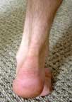 achilles tendon