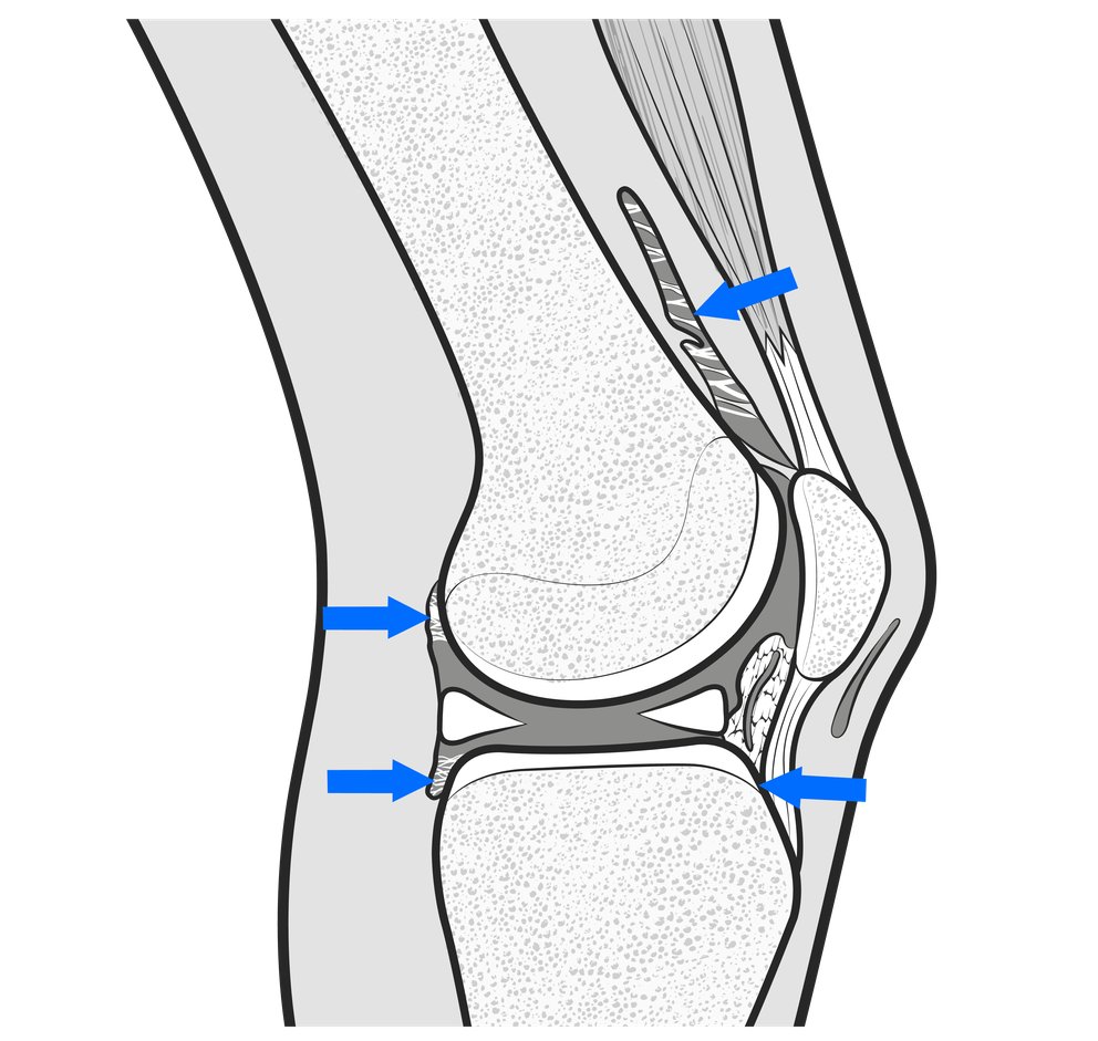 adhesions0825
