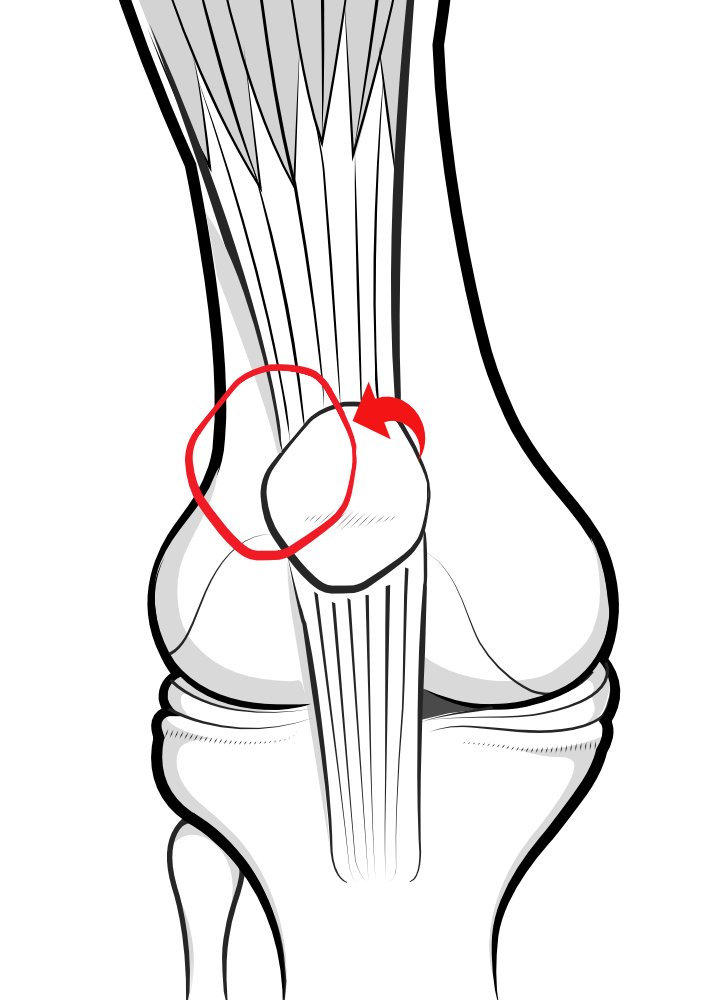 Illustration of front of the knee, to show the position of a high-riding patella compared to the normal position.