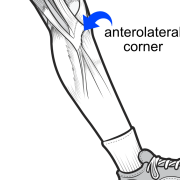 anterolateral corner