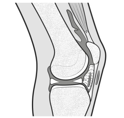 arthrofibrosis-01.png