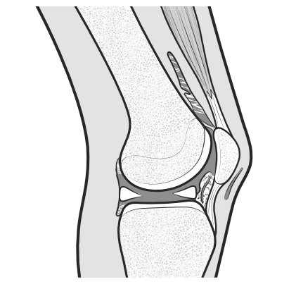 arthrofibrosis-02.png
