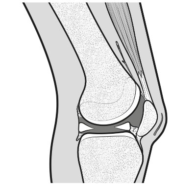 arthrofibrosis-03.png