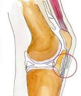 arthrofibrosis01.jpg