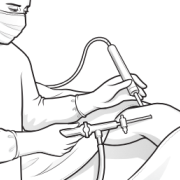lavage of joint under arthroscopic control