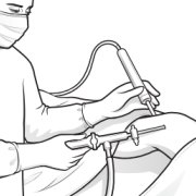 Illustration of arthroscopic surgery where a light source is passed into the knee cavity, and instruments inserted via a different portal to deal with the issue.