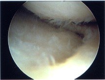 aarthroscopy