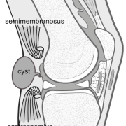 mechanism of baker's cyst