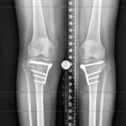 bilateral high tibial osteotomy