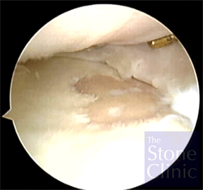 tibial plateau with eburnated bone