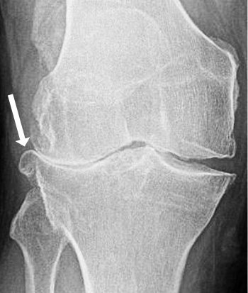 X-ray of bones of knee joint, showing joint space narrowing on the lateral side, with osteophyte formation.