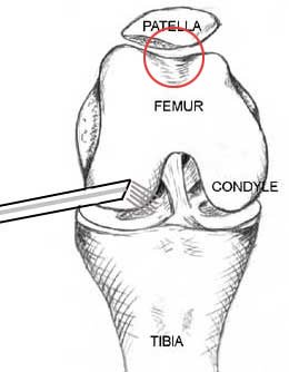 patellofemoral joint