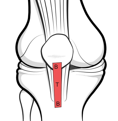 B-T-B graft harvest from patellar tendon