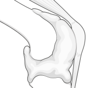 capsule of the knee inflated with effusion or haemarthrosis