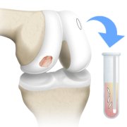 Illustration of the bones of a knee joint, where healthy cells from the edge of a cartilage defect are being harvested and sent to a laboratory.