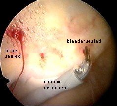 cautery during arthroscopy