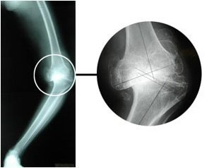 arthritis