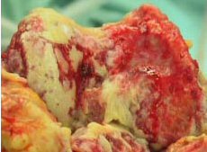arthritic knee