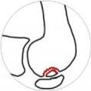 Sketch from the side of the bones of knee joint, showing the separated fragment