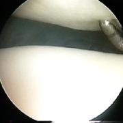 Chondromalacia - softening of the patellar joint cartilage, which The cartilage can be dimpled with a rounded probe (Grade I).