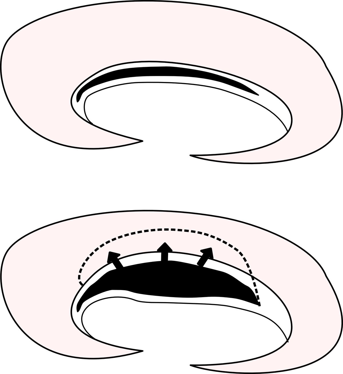 Illustration to show how a horizontal cleavage tear can suck joint fluid into it, to create a cyst.